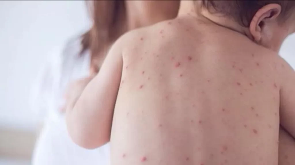 Salud Pública de Toronto confirma caso de sarampión en un bebé